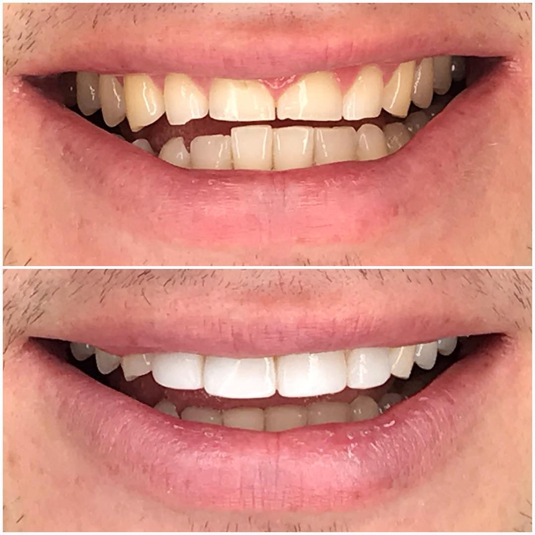 Composite Bonding Veneers Parkway Clinic Swansea 5